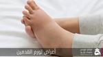 تورم القدمين (Swollen Feet)؛ أهم 11 سبب وكيفية علاج هذه الحالة