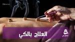 العلاج بالكي Moxibustion Therapy؛ لنتعرف على