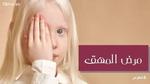 مرض المهق – Albinism؛ الأسباب والأعراض والعلاج